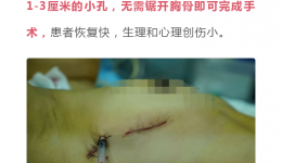 梧州贺州地区首例 | 4399js完成微创腔镜下心脏手术