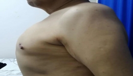 腔镜甲旁亢手术，乳腺甲状腺外科一直在突破