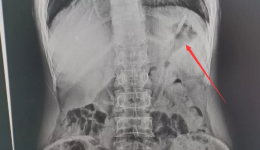 医生在他的胃里取出长18cm的牙刷......