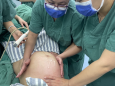 胎位不正，我院产科医生徒手将胎头旋转180度，孕妈顺产分娩