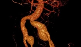 腹中大血管鼓5个“包”，我院专家运用IBD支架解除患者血管“炸弹”危机