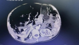25cm，15.6斤！我院成功切除一例右肾罕见巨大错构瘤