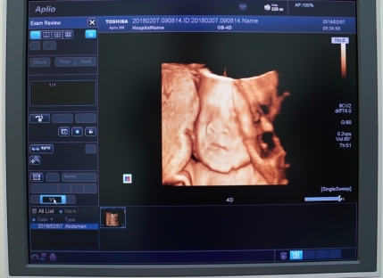 东芝Aplio500胎儿四维彩超