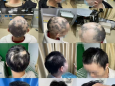 用自己的血治疗脱发，这是什么新技术？