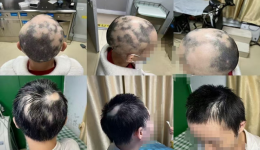 用自己的血治疗脱发,这是什么新技术?