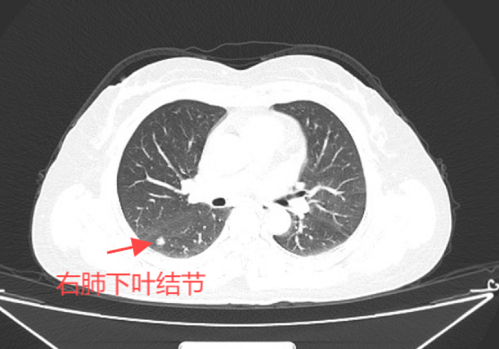 双微创！单孔胸腔镜+不插管手术，肺癌手术竟然还能这样做......