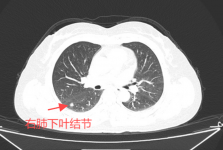 双微创！单孔胸腔镜+不插管手术，肺癌手术竟然还能这样做......