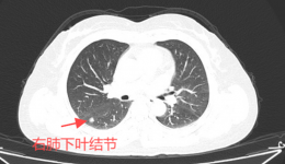 双微创!单孔胸腔镜+不插管手术,肺癌手术竟然还能这样做......