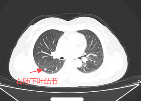 双微创！单孔胸腔镜+不插管手术，肺癌手术竟然还能这样做......