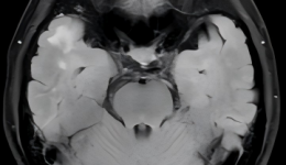 人文桂东·罕见病① | 抽丝剥茧，只为每一个生命不被辜负