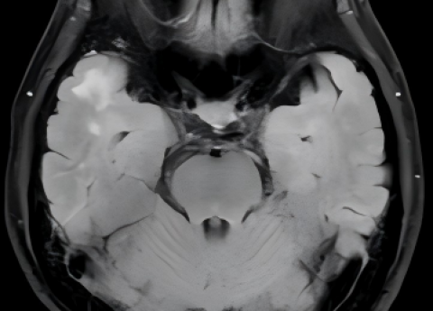 人文桂东·罕见病① | 抽丝剥茧，只为每一个生命不被辜负